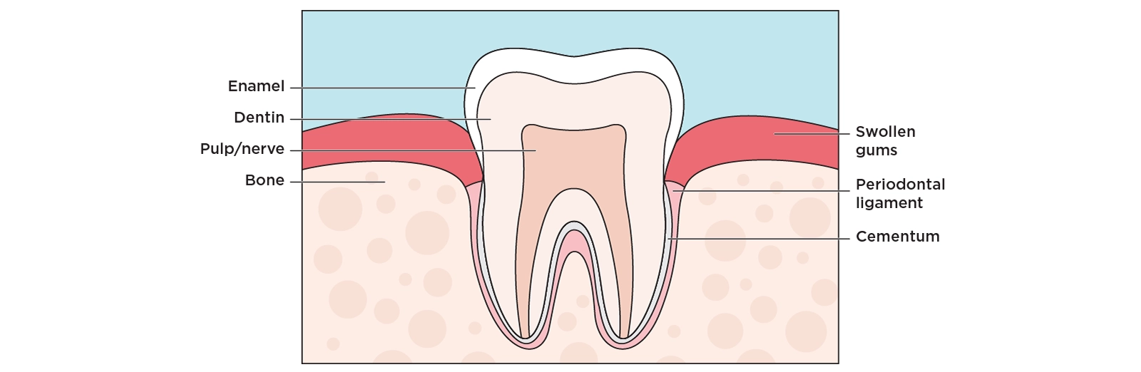 Illustration of a cross section of a tooth showing swollen gums surrounding a tooth