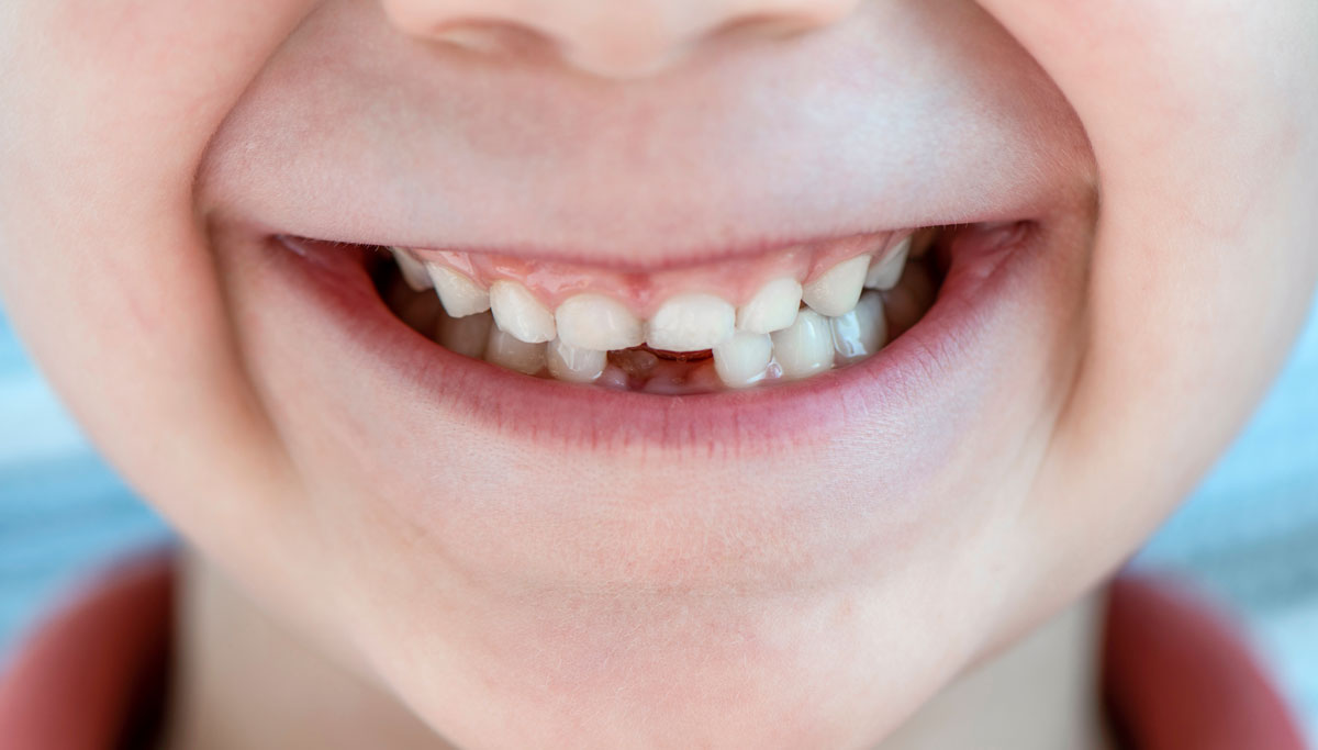 Temporary baby teeth have a long-lasting effect